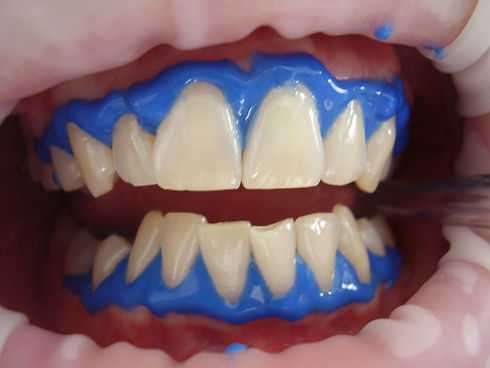 laser-teeth-whitening-716468_1920.jpg