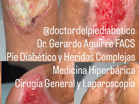 Pie diabético: amputación de primer dedo con hueso expuesto antes de acudir con nosotros