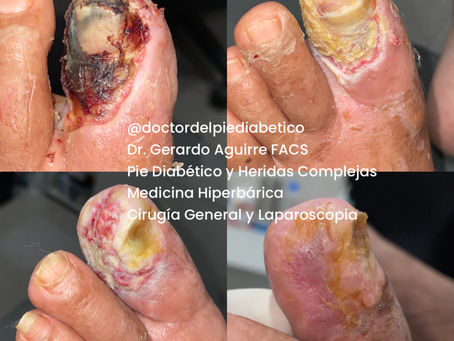 Salvar un dedo en pie diabético es posible cuando se actúa a tiempo: evaluación vascular, control de infección, desbridación avanzada, descarga adecuada y oxigenoterapia hiperbárica son pilares clave para evitar amputaciones innecesarias.