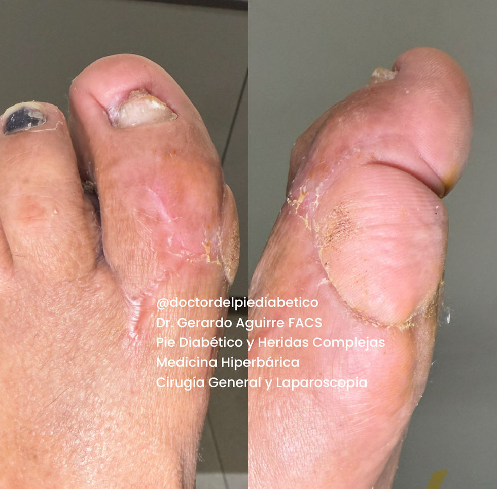 Pie diabético recuperado tras tratamiento, sin necesidad de amputación