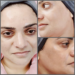 results after microneedling at beauty quantum aesthetics in high wycombe