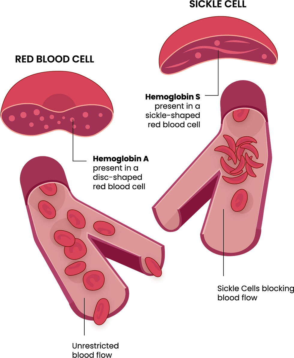 Sickle Cell Illustration-EN0.png
