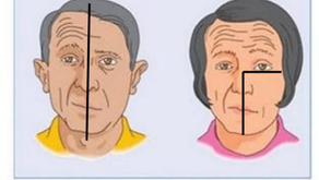 Paralisia Facial e os Olhos: O Que Você Precisa Saber ?