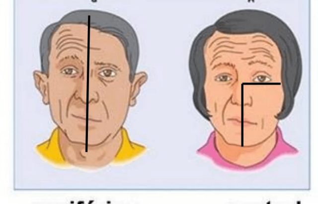 Paralisia Facial e os Olhos: O Que Você Precisa Saber ?