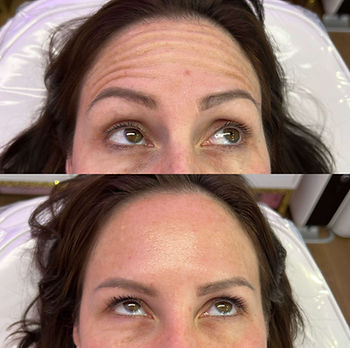 botox anti wrinkle injections in norwich, norfolk