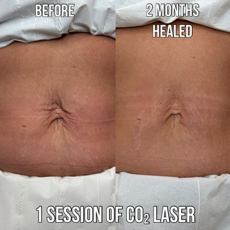 Before and after abdominal fractional CO2 laser treatment after one session