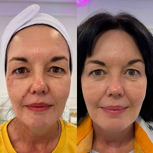Full-face CO2 laser before and after showing improved skin texture and lines