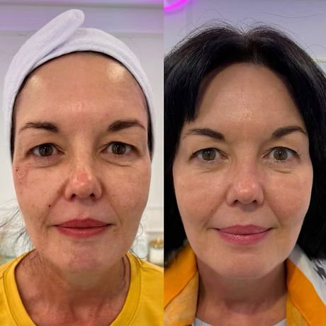 Before and after intensive full-face fractional CO2 laser treatment