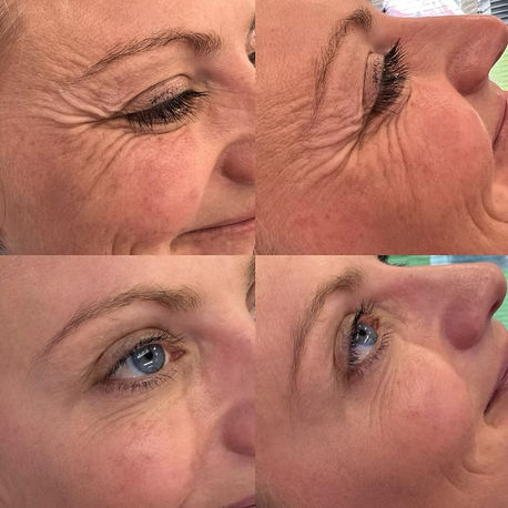 Before and after crow’s feet anti-wrinkle treatment around the eyes