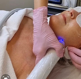 MICRONEEDLING OG RADIOFREKVENS Trondheim, Clementine Day Spa