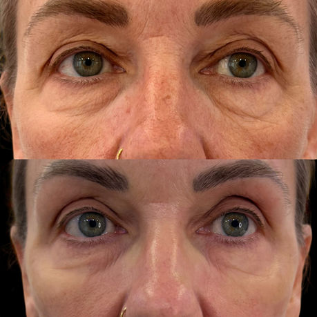 Before and after fractional CO2 laser resurfacing around the eyes