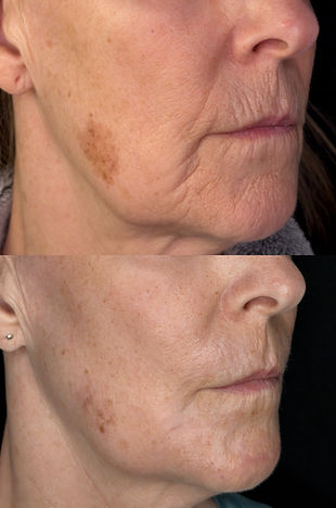 Before and after intensive CO2 laser treatment for upper-lip and perioral lines