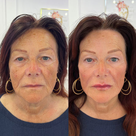 Before and after full-face dermal filler facial rebalancing
