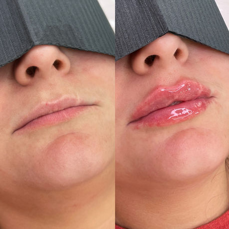 Before and after Signature lip filler result