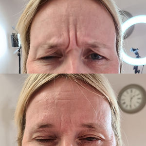 botox anti-wrinkle injections norwich