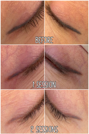 Before and after laser removal of semi-permanent eyeliner tattoo