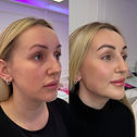 Jawline contouring dermal filler treatment Norwich