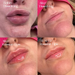 Before and after lip filler dissolving Norwich | Alison Mary Aesthetic Clinic
