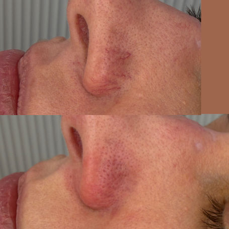 Before and after facial thread vein removal using thermocoagulation