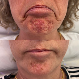 Downturned smile lift before and after result of DAO treatment (2 weeks)