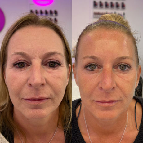 Before and after full-face anti-wrinkle treatment result