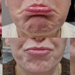 DAO Botox before and after for downturned mouth corners in Norwich