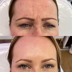 botox anti wrinkle injections norwich