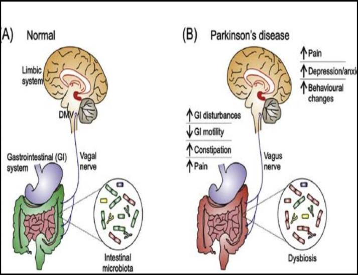 Parkinson's Disease and Constipation Dr Hiba Ismail
