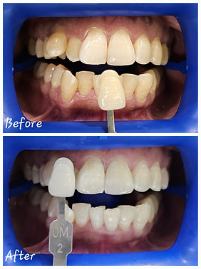 teeth whitening at prashanth dental clinic vanasthalipuram.jpg