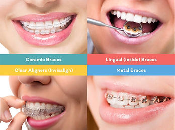 How to choose braces?