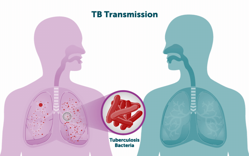 Pulmonary Tuberculosis