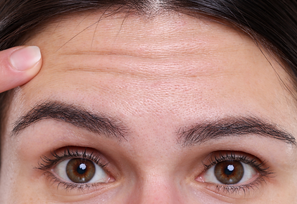 Frontalis_ forehead wrinkle