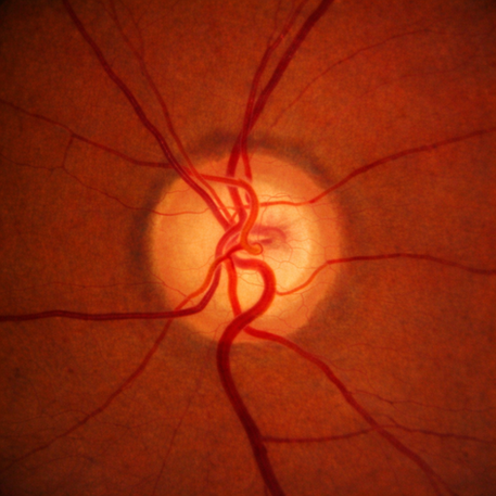 Fotografia do nervo óptico na retina usada para avaliação de glaucoma