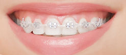 Dental braces in happy womans mouths through the heart. Brackets on the teeth after whiten