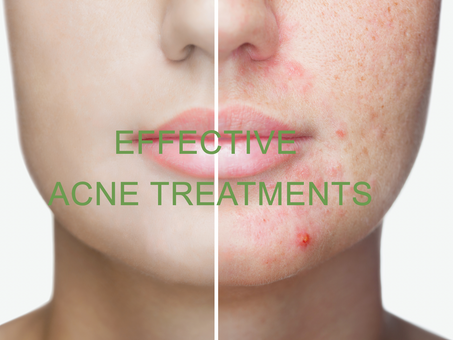 GET RID OF ACNE WITH EFFECTIVE LASER TREATMENTS
