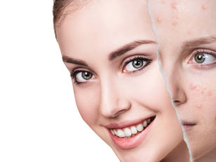 Effective treatments for acne scarring