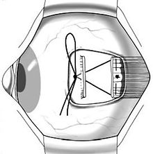 41433_2011_Article_BFeye2011167_Fig1_HTML (1).jpg