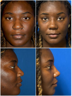 Rhinoplasty, Larry A Sargent, MD