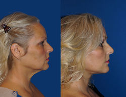 18 Facelift, Larry A Sargent MD FACS