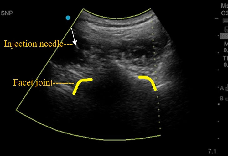 Ultrasound Guided Injection