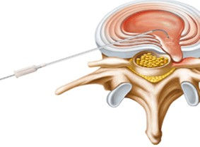 Slipped disc RF treatment