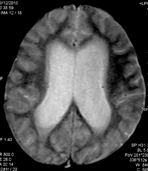 Brain Tumor2.png