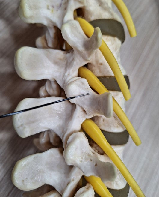 Back pain(RF) treatment