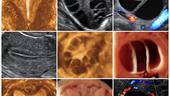 TRANSVAGINAL GINECOLÓGICA