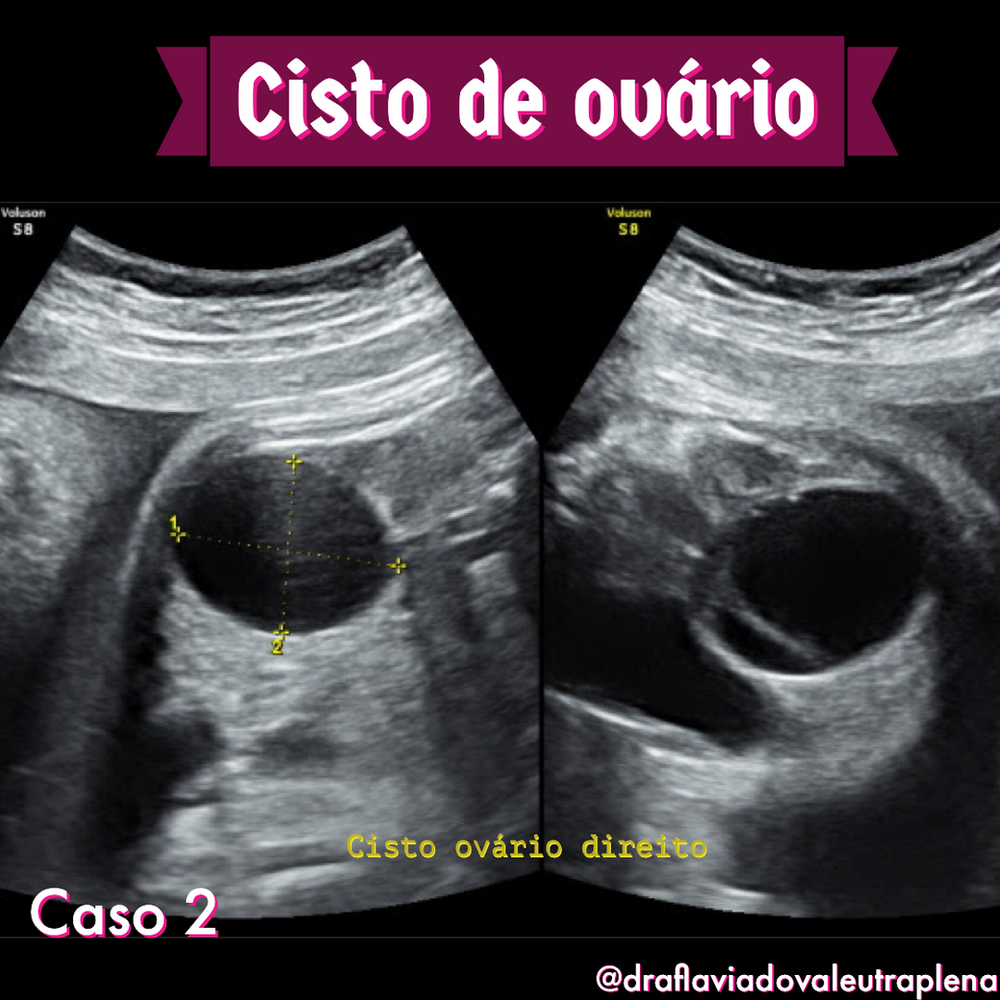 Qual O Tamanho Normal De Um Cisto No Rim