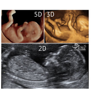 Qual E A Diferenca Entre Ultrassom 2d 3d 4d 5d