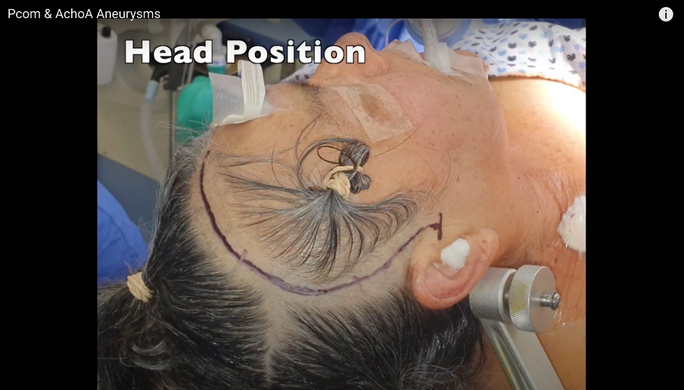 Clipping pCom and AChA aneurysm