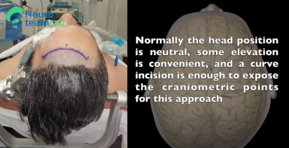 Interhemispheric approach