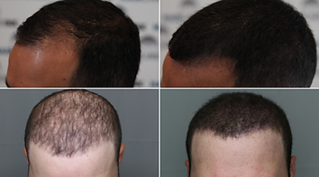 adding density to thinning hair