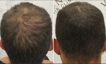 Scalp Micropigmentation Facial Xpressions Makeup And Microblading